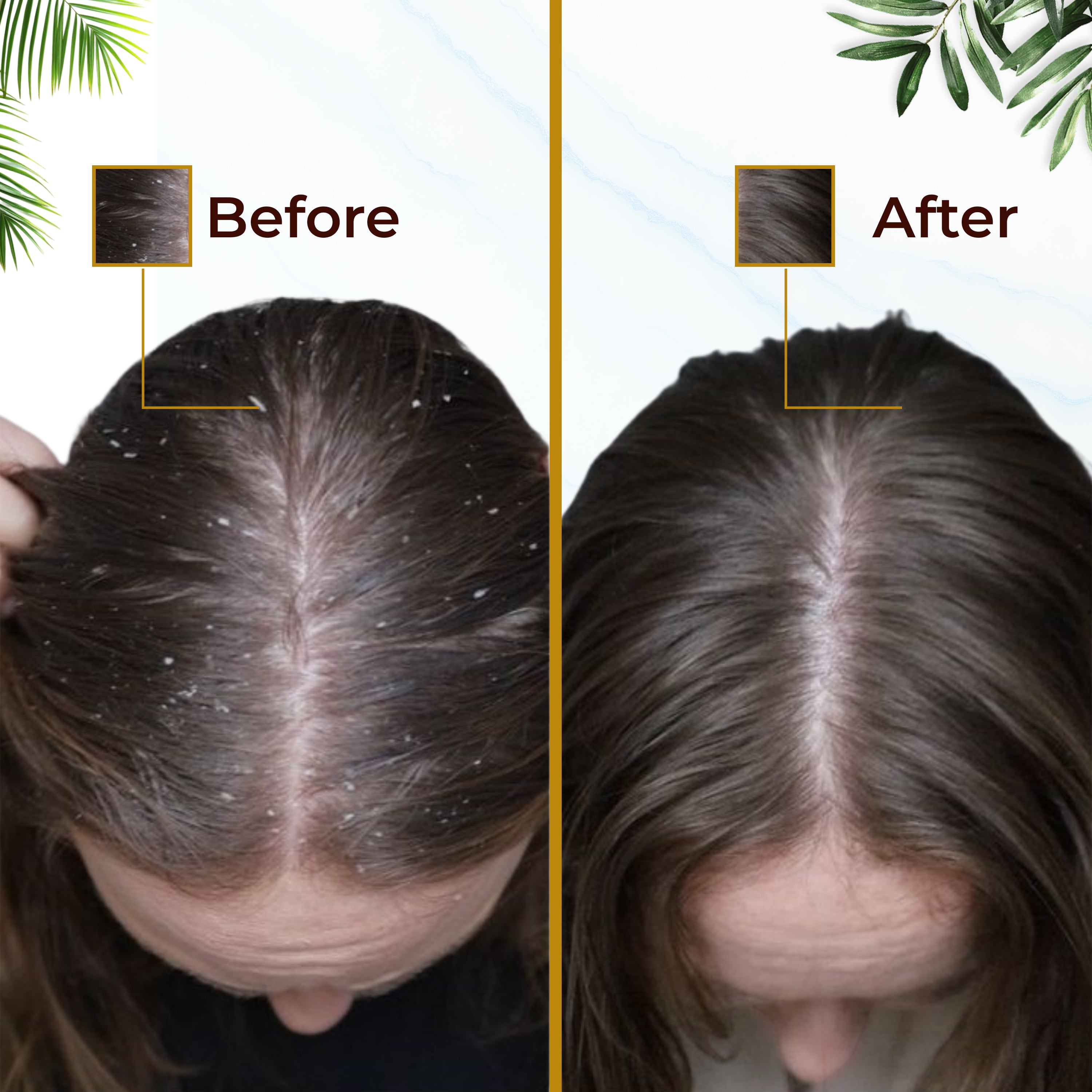 Leucita Anti Dandruff Shampoo & Conditioner Combo Salicylic Acid, Tea Tree & Neem for Flake-Free, Healthy Scalp